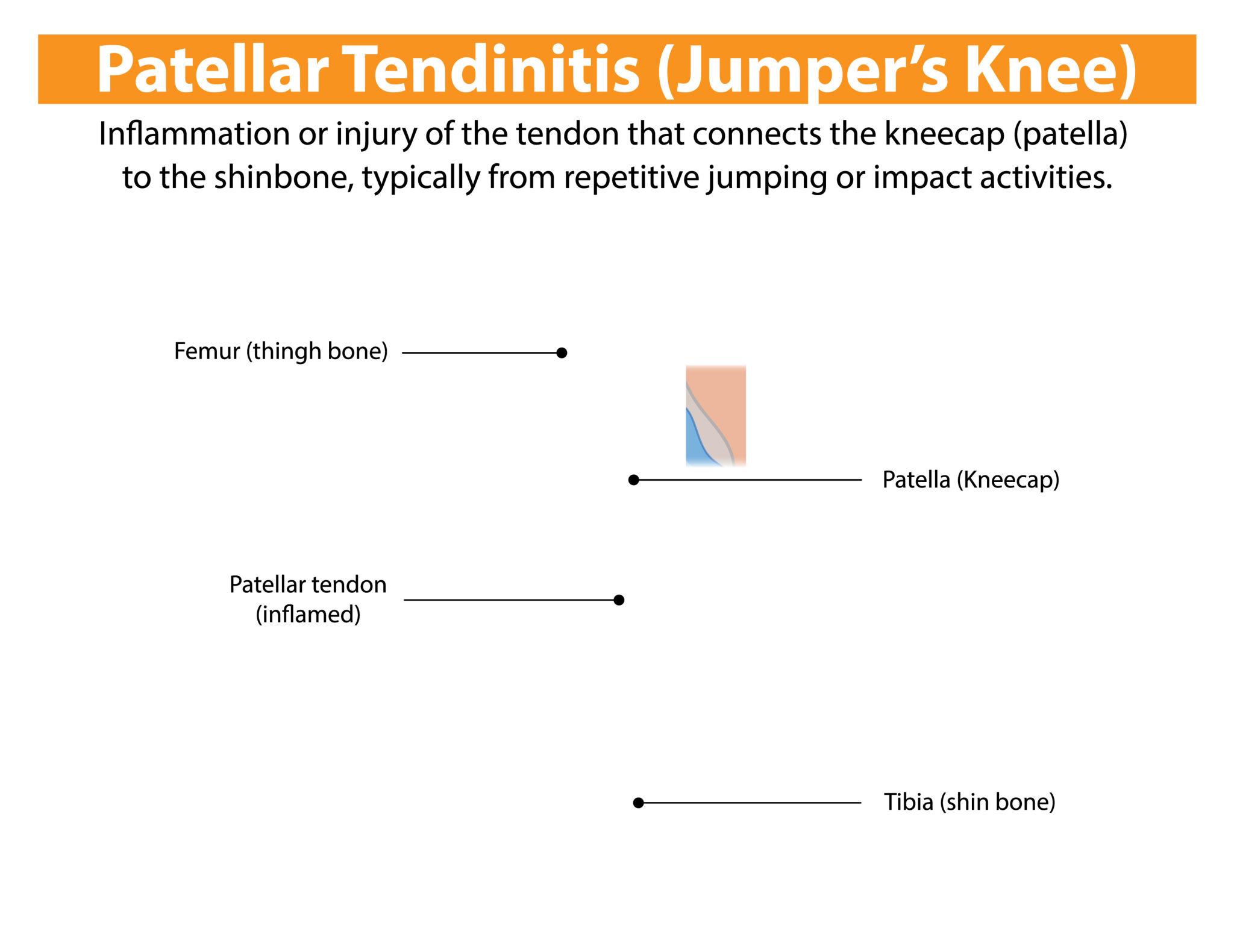 Anatomy diagram showing patellar tendon inflammation in knee
